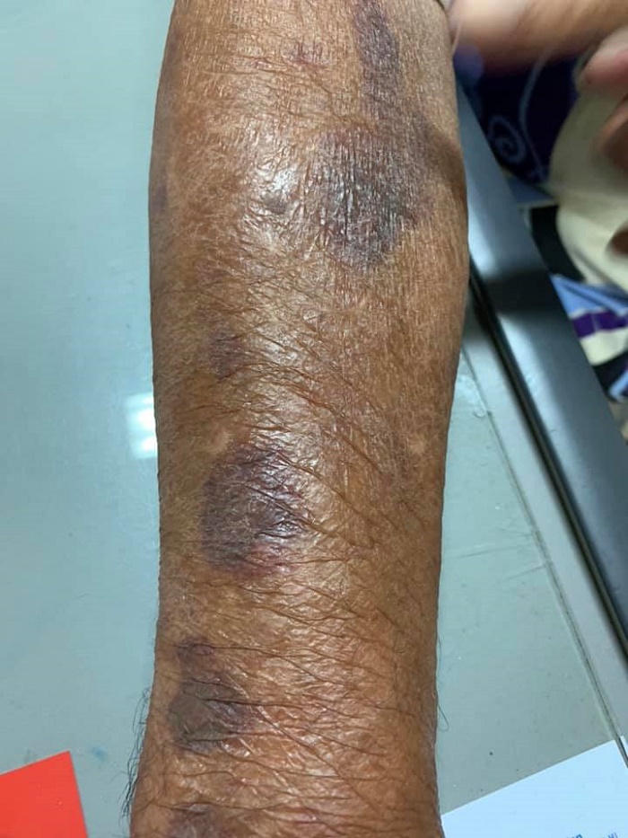kesan lebam di tangan