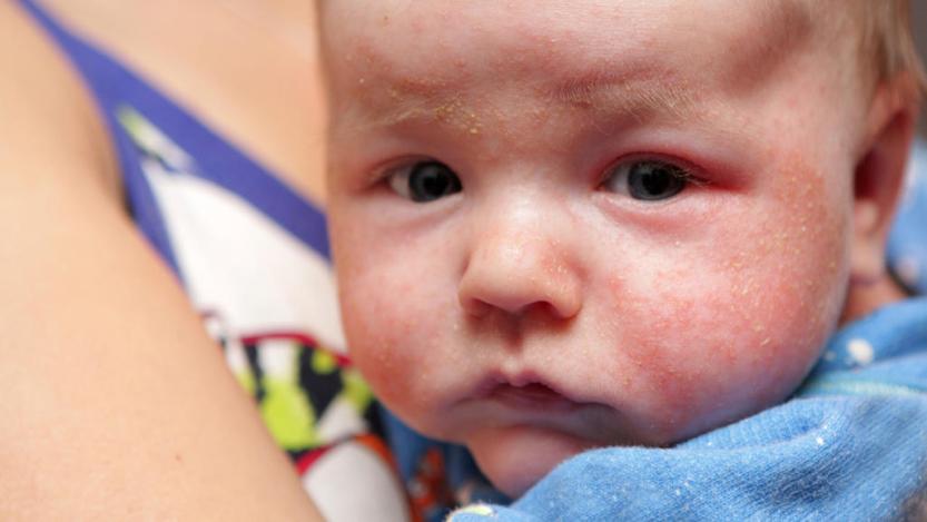 Ubat Eczema Untuk Bayi Tips Hilangkan Eczema Cara 