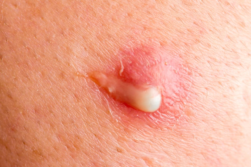 10 Jenis Penyakit Kulit Yang Biasa Menyerang Rakyat Malaysia